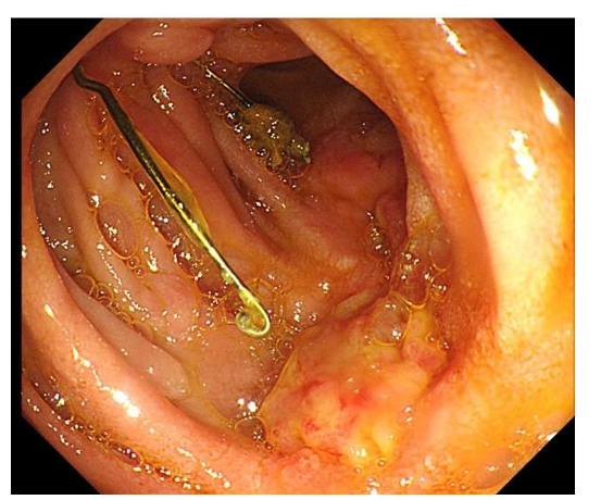 Duodenal Perforation by Inferior Vena Cava Filter. A Rare Cause of Recurrent  Abdominal Pain