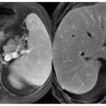 Schistosomiasis Presenting as A Liver Mass in A Resident of Turkiye Without Overseas  Travel: A Case-Based Review Running Title: Schistosomiasis Presenting as A Liver Mass  in A Resident of Türkiye