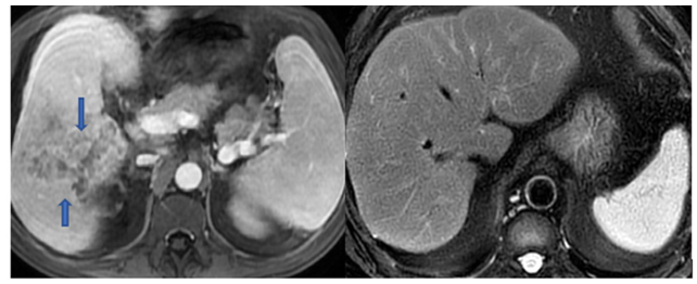 Schistosomiasis Presenting as A Liver Mass in A Resident of Turkiye Without Overseas  Travel: A Case-Based Review Running Title: Schistosomiasis Presenting as A Liver Mass  in A Resident of Türkiye