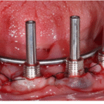 Intraoral Welding Technique in Oral Implants