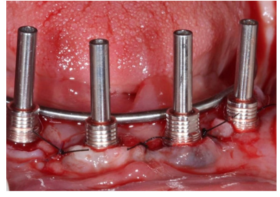 Intraoral Welding Technique in Oral Implants