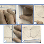 PhasixTM non-ST Mesh for Giant Paraoesophageal Hernias – The Way of the Future?