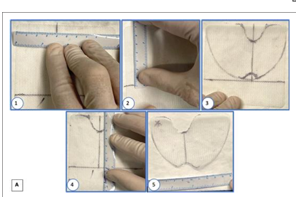 PhasixTM non-ST Mesh for Giant Paraoesophageal Hernias – The Way of the Future?