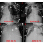VA-ECMO in Managing Respiratory Failure and Severe Infection in an Low-Weight Infant Following Liver Transplantation: Case Report and Literature Review