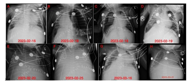 VA-ECMO in Managing Respiratory Failure and Severe Infection in an Low-Weight  Infant Following Liver Transplantation: Case Report and Literature Review