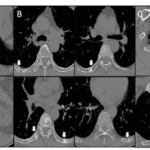 A Case of Fanconi Syndrome with Multiple Fractures and Height Loss as Main Symptoms Caused by Adefovir Dipivoxil