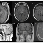 Extrapontine Osmotic Demyelination with Pituitary Necrosis Following Severe Hyponatremia: A Rare Neuroendocrine Intersection