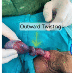 Lateral (Counterclockwise) 1440° Testicular Torsion: A Rare Surgical Observation