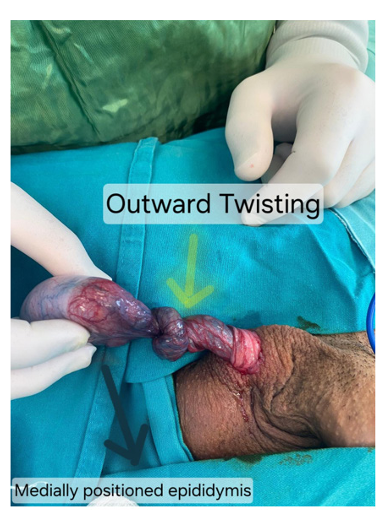 Lateral (Counterclockwise) 1440° Testicular Torsion: A Rare Surgical Observation