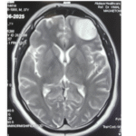 Pharmacological Awakening: An indispensable tool for Awake Craniotomy: A Case Report