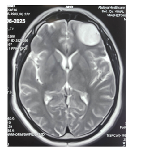 Pharmacological Awakening: An indispensable tool for Awake Craniotomy: A Case Report