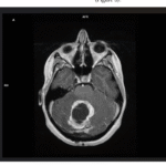 Long-Term Treatment With BRAF/MEK Inhibitors for Pleomorphic Xanthoastro-  cytoma Grade 3: A Case Report