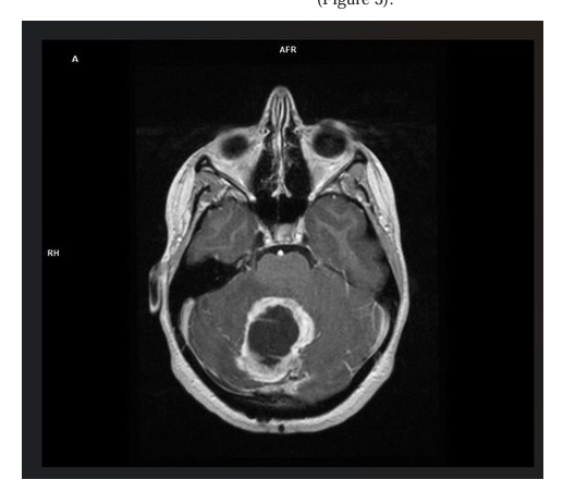Long-Term Treatment With BRAF/MEK Inhibitors for Pleomorphic Xanthoastro-  cytoma Grade 3: A Case Report