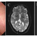 Late-onset Cerebrotendinous Xanthomatosis with Mild Symptoms: A Case Report