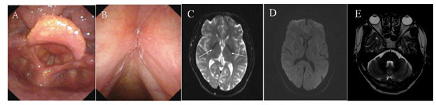 Late-onset Cerebrotendinous Xanthomatosis with Mild Symptoms: A Case Report