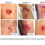 At-Home, Patient-Applied Collagen–Manuka Honey–Hydroxyapatite Dressing for  Post- Mohs Surgical Sites: An Eight-Patient Case Series