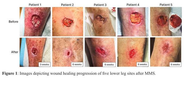 At-Home, Patient-Applied Collagen–Manuka Honey–Hydroxyapatite Dressing for  Post- Mohs Surgical Sites: An Eight-Patient Case Series