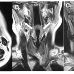 Case Report: Pembrolizumab-Induced Epiglottitis in Early Triple Negative Breast  Cancer