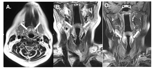 Case Report: Pembrolizumab-Induced Epiglottitis in Early Triple Negative Breast  Cancer