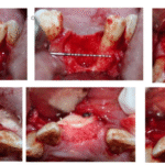 Horizontal and Vertical Ridge Augmentation Utilize Allogeneic Bone Block Graft  in Anterior and Premolar Area Prior To Implant Placement Follow Up 2 Years