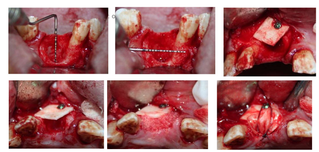 Horizontal and Vertical Ridge Augmentation Utilize Allogeneic Bone Block Graft  in Anterior and Premolar Area Prior To Implant Placement Follow Up 2 Years