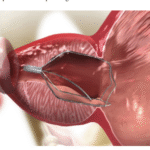 Expanding the Role of iTind®: First Clinical Experience in Treating Bladder Neck  Contracture Following TURP
