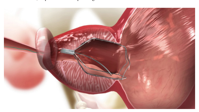 Expanding the Role of iTind®: First Clinical Experience in Treating Bladder Neck  Contracture Following TURP