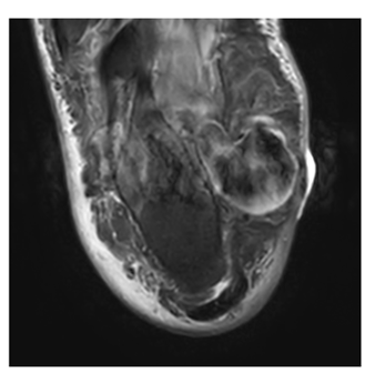 Mycotic Posterior Tibial Artery Aneurysm in a Patient with Diabetes: A Case Report