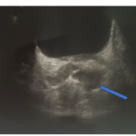Invasive Klebsiella Pneumoniae Liver Abscess Syndrome Accompanied by Seminal  Vesiculitis and Prostate Abscess in a Non-Diabetic Patient