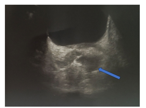 Invasive Klebsiella Pneumoniae Liver Abscess Syndrome Accompanied by Seminal  Vesiculitis and Prostate Abscess in a Non-Diabetic Patient