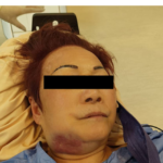 Intravenous Recombinant Tissue Plasminogen Activator (Rt-PA) Induced Life-Threatening  Angioedema