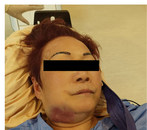 Intravenous Recombinant Tissue Plasminogen Activator (Rt-PA) Induced Life-Threatening  Angioedema