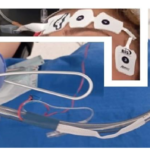 Thoracoscopic Neuroprotective Phrenotomy; A New Surgical Technique for Idio-  pathic Incurable Chronic Hiccups