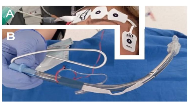 Thoracoscopic Neuroprotective Phrenotomy; A New Surgical Technique for Idio-  pathic Incurable Chronic Hiccups