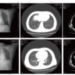 ANCA-Associated Vasculitis Masquerading as Refractory Pneumonia: A Diagnostic Challenge and Lessons Learned