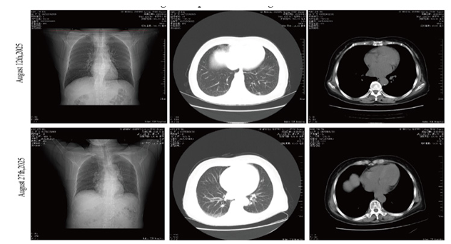 ANCA-Associated Vasculitis Masquerading as Refractory Pneumonia: A Diagnostic Challenge and Lessons Learned