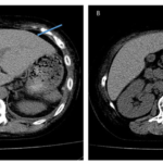 A Complex Autoimmune Case Complicated by Cat Scratch Disease