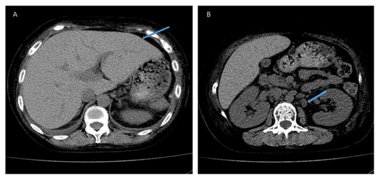 A Complex Autoimmune Case Complicated by Cat Scratch Disease
