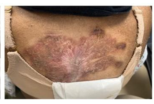 Postoperative Pyoderma Gangrenosum: A Diagnostic Challenge