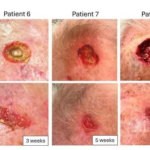 At-Home, Patient-Applied Collagen–Manuka Honey–Hydroxyapatite Dressing for  Post- Mohs Surgical Sites: An Eight-Patient Case Series