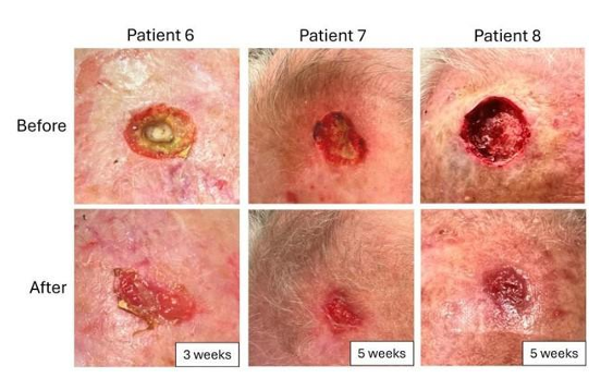 At-Home, Patient-Applied Collagen–Manuka Honey–Hydroxyapatite Dressing for  Post- Mohs Surgical Sites: An Eight-Patient Case Series