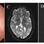 Late-onset Cerebrotendinous Xanthomatosis with Mild Symptoms: A Case Report