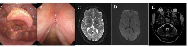 Late-onset Cerebrotendinous Xanthomatosis with Mild Symptoms: A Case Report